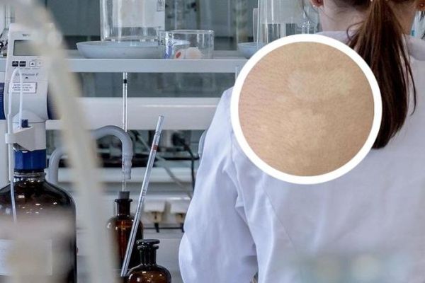 双鱼癫是什么病_双鱼癫早期症状有哪些